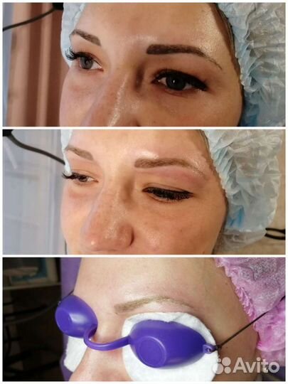 Удаление татуажа лазером/ эпиляция