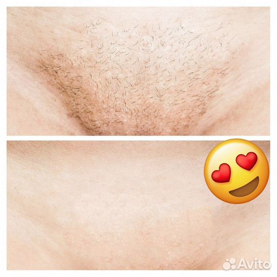 Лазерная эпиляция Санкт-Петербург