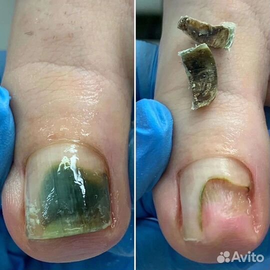 Подолог. Парамедицинский педикюр