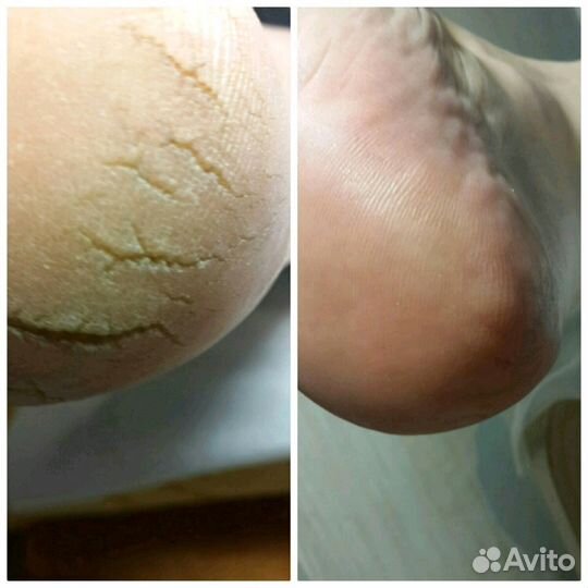 Вросший ноготь, трещены, мозоли, бородавки