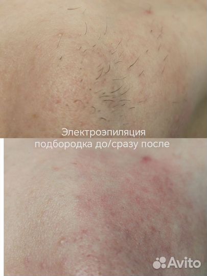 Депиляция(воск, шугаринг), электроэпиляция