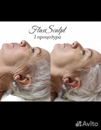 Пептидное армирование лица