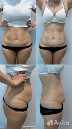 Индиба похудение, коррекция