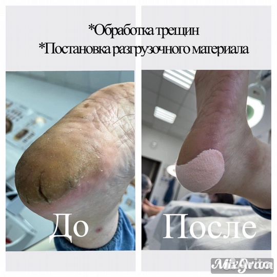 Педикюр подолог