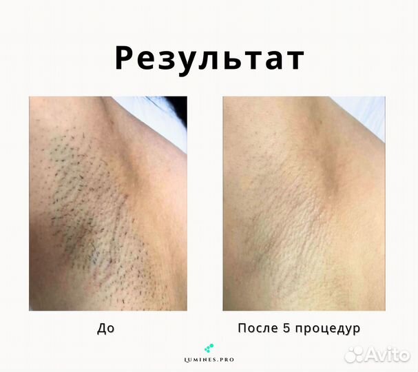 Диодный лазер для эпиляции Люминес’ максван 1200 Вт