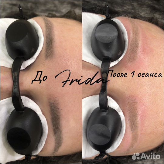 Лазерное удаление татуажа и татуировок