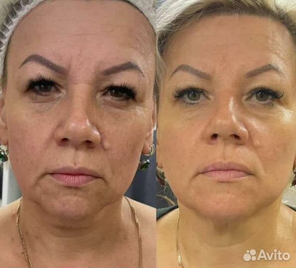 Скульптурный массаж лица