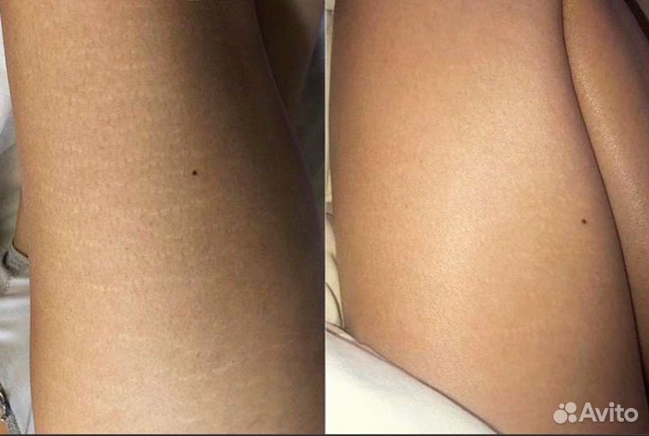 Камуфляж шрамов,растяжек