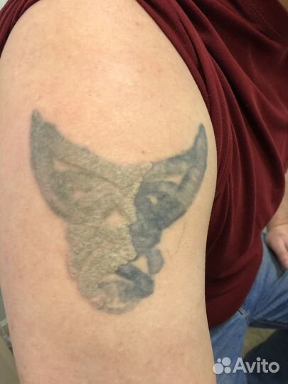 Удаление татуажа и тату лазером