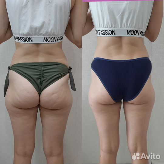 Кавитация, вакум, лазерный липолиз, рф-лифтинг