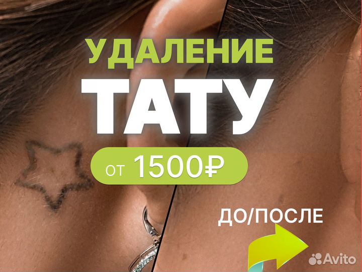 Лазерное удаление татуировок и татуажа