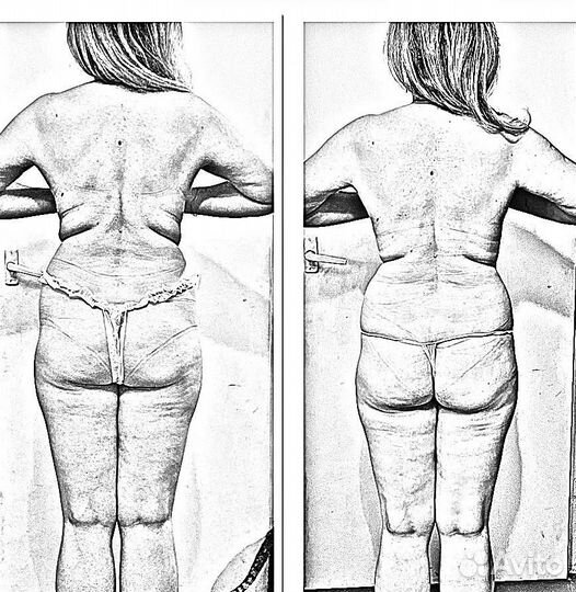 Похудение, коррекция фигуры