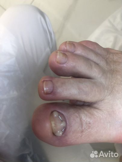 Подолог.Вросший ноготь