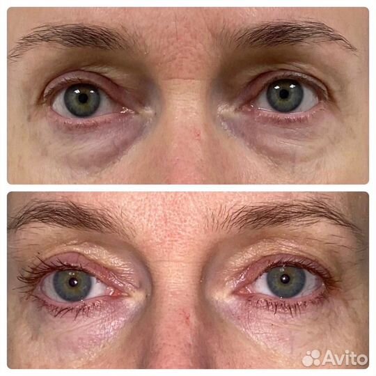 Миофасциальный массаж лица