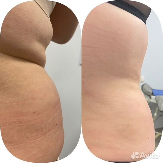 Аппаратное похудение Коррекция фигуры