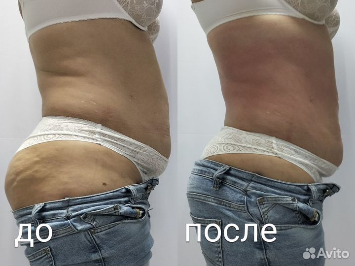 Антицеллюлитный Массаж Тела