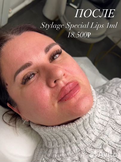 Контурная пластика губ