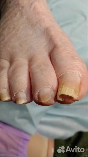 Медицинский педикюр с выездом на дом