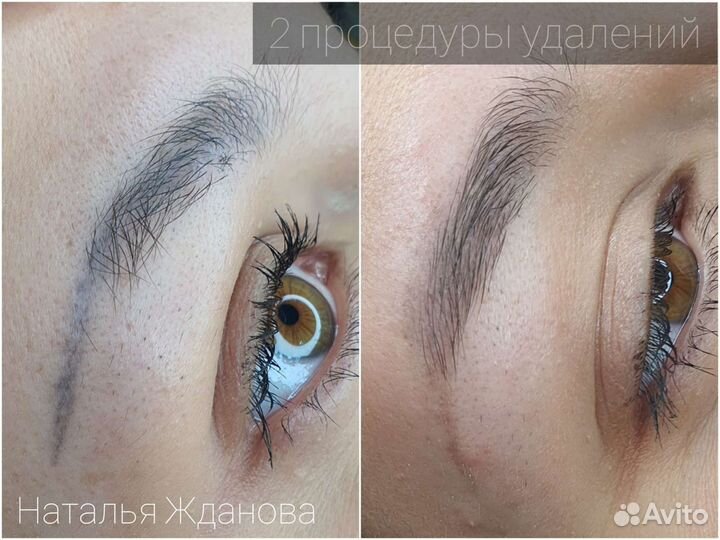 Удаление татуажа перманентного макияжа