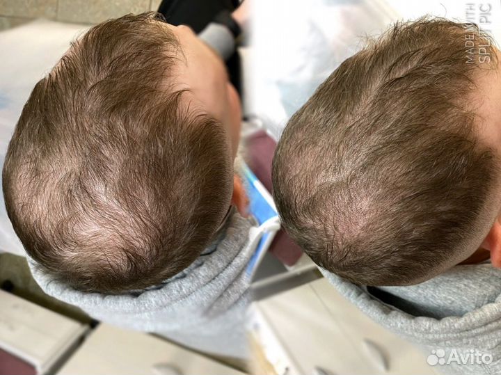 Трихопигментация головы