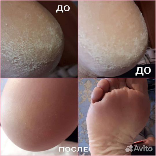 Педикюр любой сложности