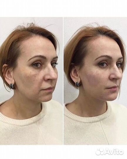 Смас лифтинг