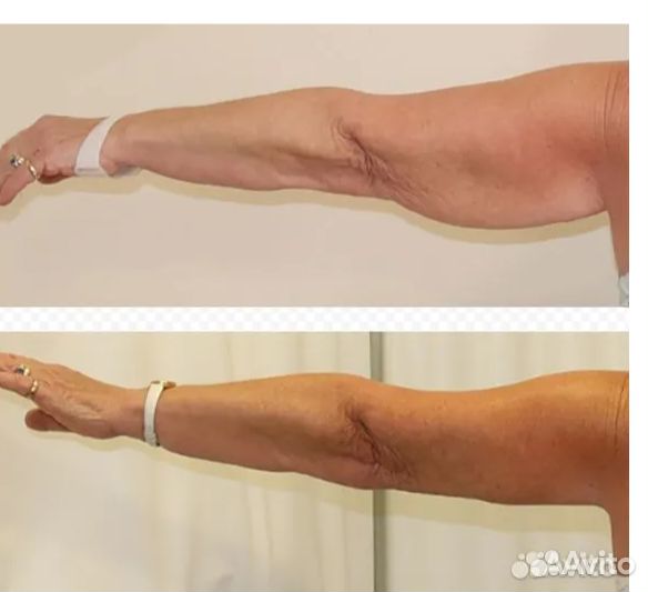 Стройные руки, удаление жира навсегда в Перми