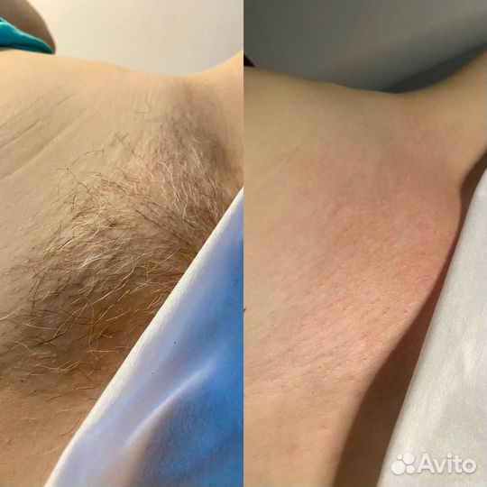 Шугаринг (Химки. ЖК «Две столицы»)