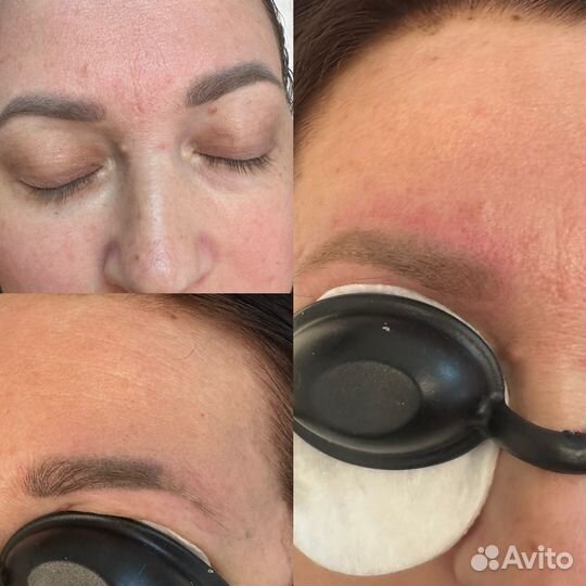 Удаление татуажа лазером