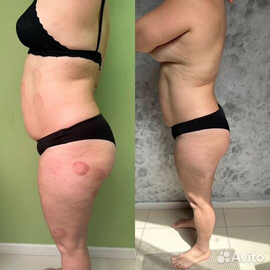 Аппаратный вакуумный массаж вибромассаж