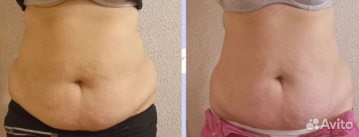 Холодная плазма - супер омоложение без уколов