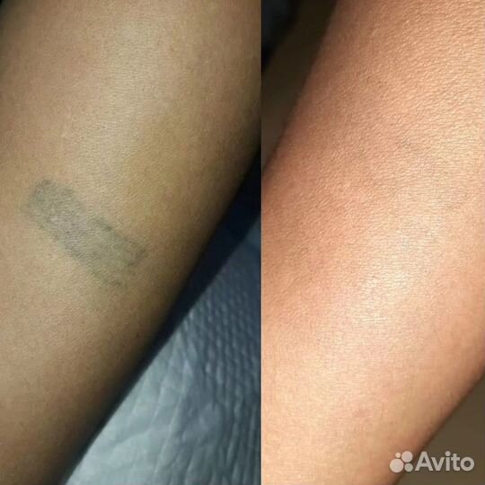 Лазерное удаление татуировок и татуажа