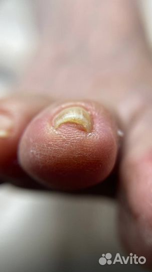 Вросший ноготь педикюр