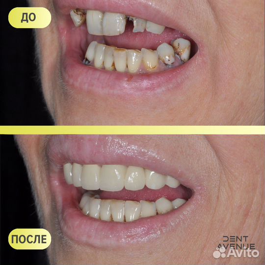 Виниры и коронки на зубы