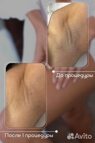 Студия лазерной эпиляции