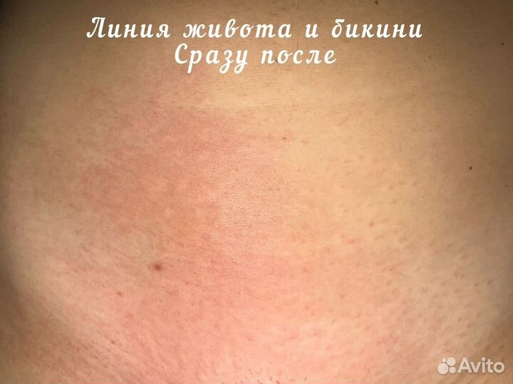 Электроэпиляция Апилус Apilus