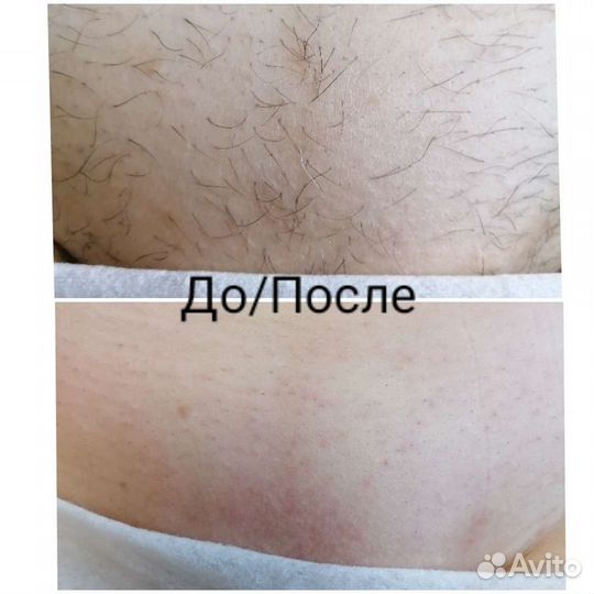 Шугаринг: бёдра