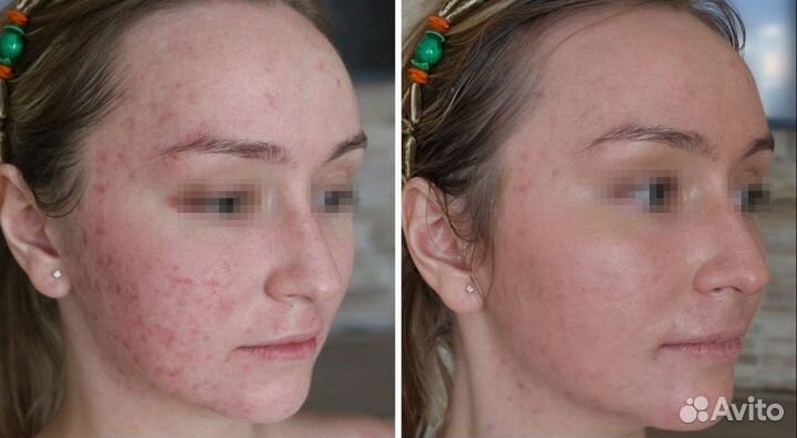 Лечение акне и постакне аппаратное