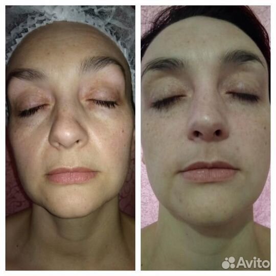 Антицеллюлитный и классический массаж