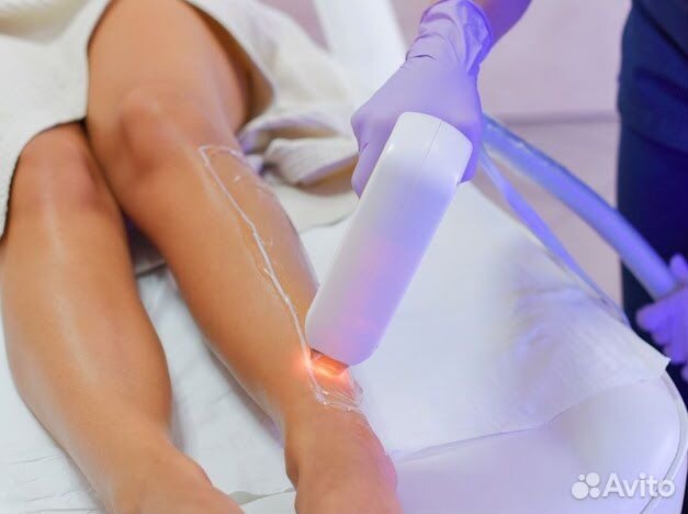 Лазерная эпиляция