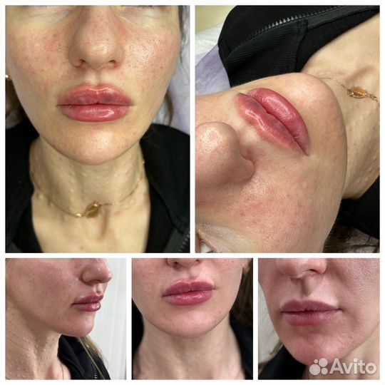 Увеличение губ плоский бант, ботокс