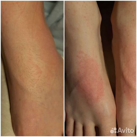 Электроэпиляция