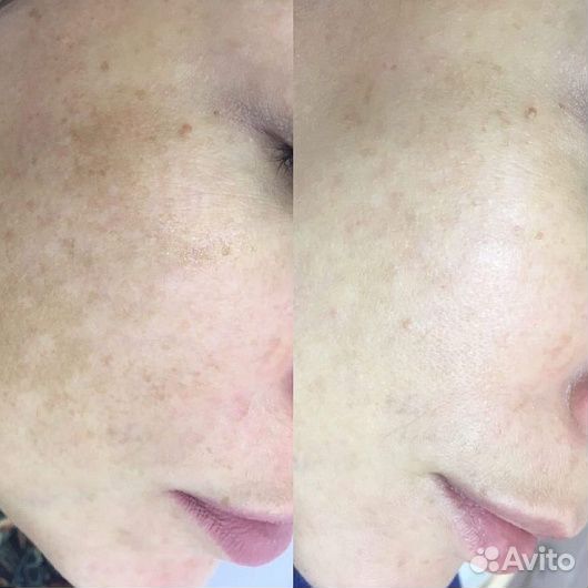 От пигментации крем Ингибитор. Мирра