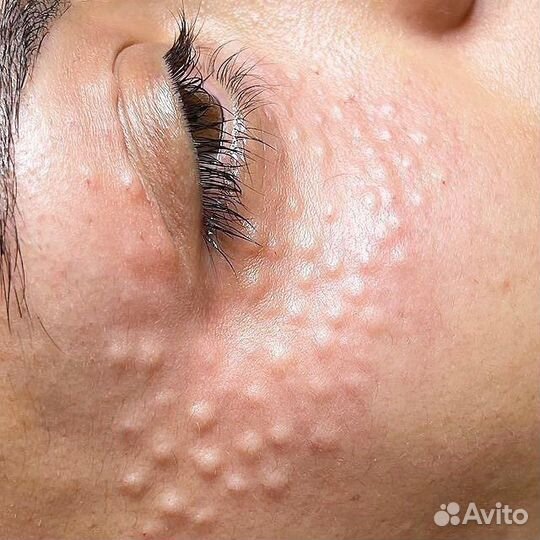 Коктель Монако Мезотерапия биоревитализация пилинг