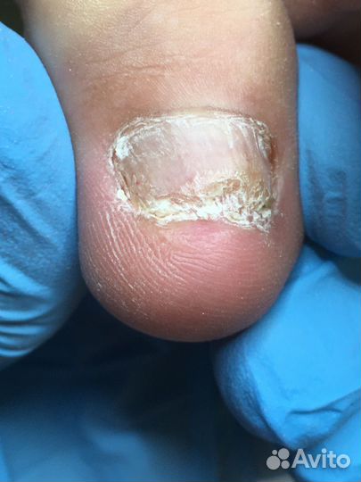 Услуги подолога / выезд на дом