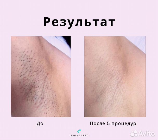 Диодный лазер для эпиляции Lumines’ Макс-Ван 1200