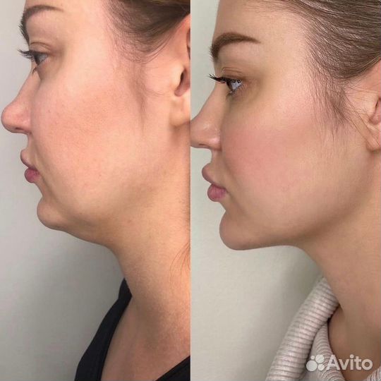 Липолитики, худое лицо, стройное тело, жиротоп