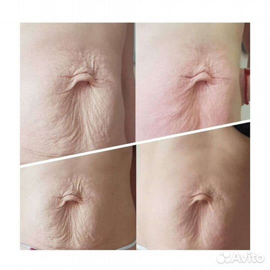 Кавитация, вибро массаж, LPG массаж