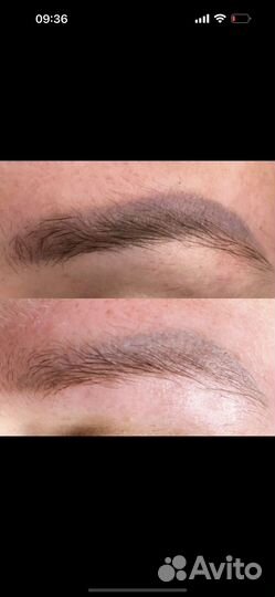 Удаление тату и татуажа лазером