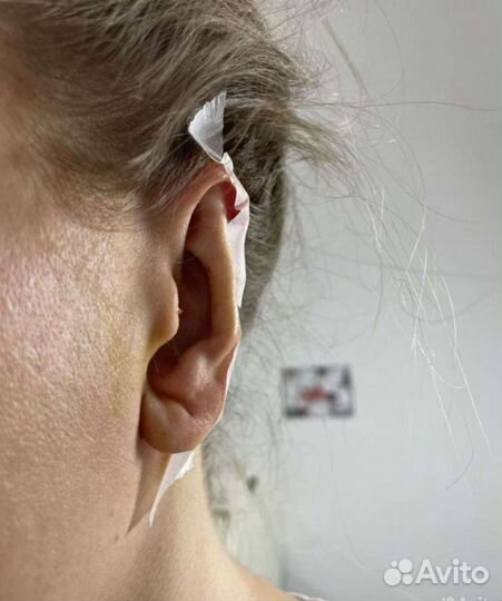 Отопластика нитевая